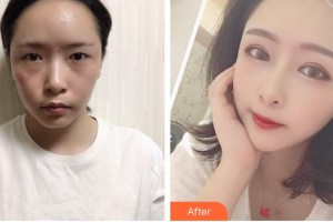 呼和浩特京美醫(yī)療形美容醫(yī)院朱京成整形價(jià)格表附眼部綜合案例展示