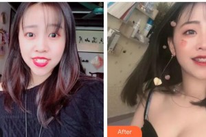 呼和浩特董志新口腔門(mén)診部董志新整形價(jià)格表附金屬托槽矯正案例展示