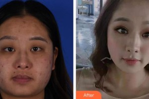 呼和浩特朝聚眼科醫(yī)院張貴森整形價(jià)格表附眼部綜合案例展示