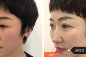 包頭麗人婦產(chǎn)醫(yī)院醫(yī)學(xué)美容科孫武堅(jiān)整形價(jià)格表附去痘印痘坑例展示