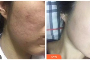 包頭中心醫(yī)院燒傷整形美容科姚炎燚整形價格表附微針美膚案例展示