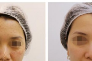 包頭葉子整形美容醫(yī)院閆侯旺整形價格表附光子嫩膚案例展示