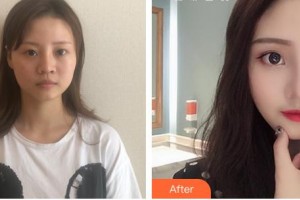 包頭李德皮膚醫(yī)院常建民整形價(jià)格表附硅膠隆鼻例展示