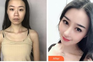 包頭李德皮膚醫(yī)院于習(xí)軍整形價格表附鼻部綜合案例展示