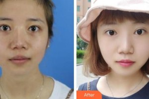 包頭李德皮膚醫(yī)院楊高云整形價(jià)格表附激光祛斑案例展示