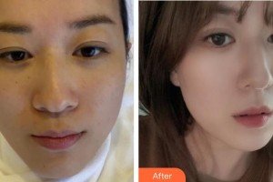 包頭劉恕醫(yī)療美容診所劉怒整形價(jià)格表附激光祛斑案例展示