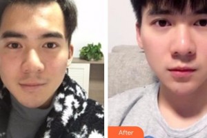 包頭李德皮膚醫(yī)院謝志強(qiáng)整形價格表附白瓷娃娃案例展示