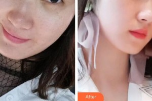 包頭華美醫(yī)療美容醫(yī)院白虎整形價(jià)格表附激光祛斑案例展示