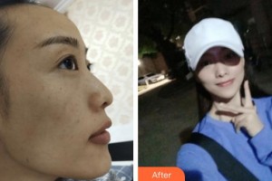 包頭聯(lián)合麗格醫(yī)療美容門(mén)診部崔曉穎整形價(jià)格表附激光祛斑案例展示