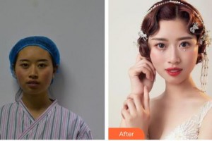 包頭時(shí)光醫(yī)療美容門(mén)診部常青整形價(jià)格表附埋線(xiàn)提升例展示