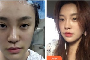 包頭聯(lián)合麗格醫(yī)療美容門(mén)診部董曉宏整形價(jià)格表附埋線(xiàn)提升案例展示