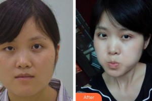 包頭朝聚眼科醫(yī)院張小利整形價格表附切開雙眼皮案例展示