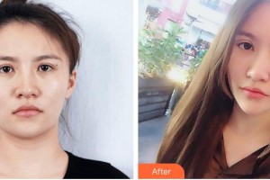 包頭麗人婦產(chǎn)醫(yī)院醫(yī)學(xué)美容科李繼偉整形價格表附埋線雙眼皮案例展示