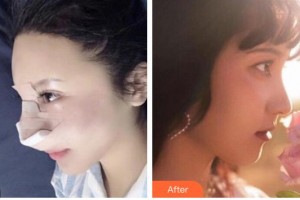 赤峰現(xiàn)代婦產(chǎn)醫(yī)院醫(yī)療美容科張守玲整形價(jià)格表附鼻部綜合案例展示