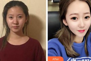 赤峰麗都整形美容醫(yī)院聶影整形價(jià)格表附鼻部綜合案例展示