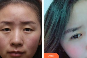 赤峰朝聚眼科醫(yī)院齊穎整形價(jià)格表附激光去眼袋案例展示