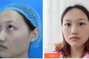 赤峰朝聚眼科醫(yī)院侯桂梅整形價(jià)格表附激光去眼袋案例展示