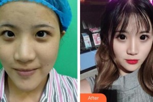 赤峰淑香醫(yī)療整形美容醫(yī)院?jiǎn)淌缦阏蝺r(jià)格表附切開雙眼皮案例展示