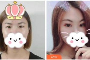 赤峰朝聚眼科醫(yī)院周躍華整形價(jià)格表附眼部綜合案例展示