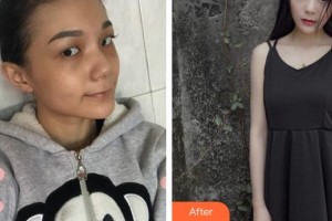 通遼京韓創(chuàng)美醫(yī)療美容診所于海波整形價(jià)格表附開內(nèi)眼角案例展示