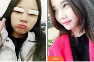 通遼施介醫(yī)院整形美容中心王瑞芝整形價(jià)格表附埋線雙眼皮案例展示