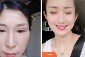 通遼馬皓醫(yī)療美容醫(yī)院馬皓整形價(jià)格表附切開雙眼皮案例展示