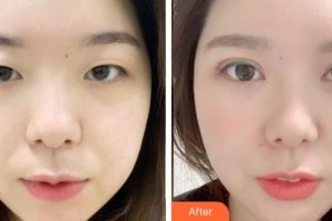 通遼京韓創(chuàng)美醫(yī)療美容診所傅群整形價(jià)格表附切開雙眼皮案例展示