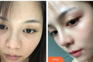 鄂爾多斯百達(dá)麗整形美容醫(yī)院劉林整形價(jià)格表附激光祛斑案例展示