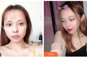 鄂爾多斯天王醫(yī)學(xué)美容醫(yī)院趙娜整形價(jià)格表附微針美膚案例展示