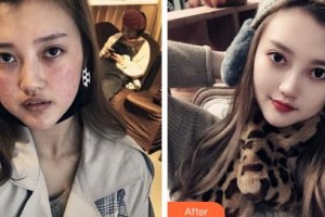 鄂爾多斯市中心醫(yī)院燒傷整形科張玉萍整形價(jià)格表附清潔祛痘案例展示