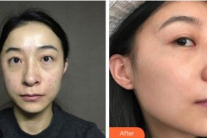 鄂爾多斯口腔醫(yī)院楊劍整形價(jià)格表附激光祛斑案例展示