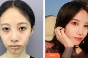 巴彥淖爾張紅田醫(yī)療整形美容診所賀新華整形價(jià)格表附眼部綜合案例展示