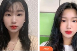 巴彥淖爾張紅田醫(yī)療整形美容診所張紅田整形價(jià)格表附眼部綜合案例展示