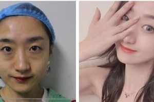 烏蘭察布美尚美醫(yī)學(xué)美容整形醫(yī)院張淼整形價(jià)格表附激光去眼袋案例展示