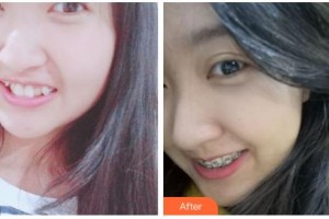 吉林銘醫(yī)整形美容醫(yī)院吳迪整形價(jià)格表附金屬托槽矯正案例展示