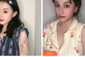 吉林銘醫(yī)整形美容醫(yī)院劉浩整形價(jià)格表附微創(chuàng)疤痕修復(fù)案例展示