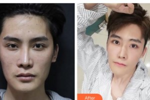 吉林大學(xué)口腔醫(yī)院口腔頜面外科彭鐵男整形價(jià)格表附牙齒隱形矯正案例展示