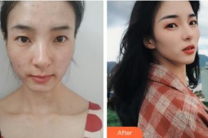 吉林大學(xué)第一醫(yī)院整形美容科邵英整形價(jià)格表附清潔祛痘案例展示