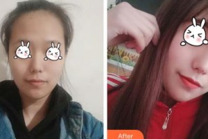 吉林大學(xué)第一醫(yī)院整形美容科林泉整形價(jià)格表附光子嫩膚案例展示