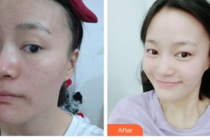 吉林國(guó)健整形美容醫(yī)院錢(qián)剛整形價(jià)格表附去痘印痘坑案例展示