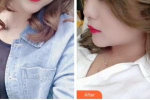 吉林大學(xué)第一醫(yī)院整形美容科金洪娟整形價(jià)格表附激光祛斑案例展示