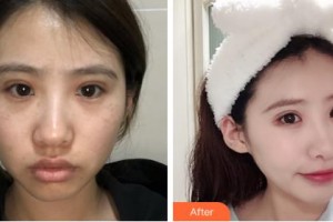 吉林國(guó)健整形美容醫(yī)院柳濟(jì)圣整形價(jià)格表附激光祛斑案例展示