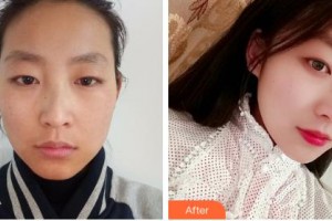 吉林大學(xué)第一醫(yī)院整形美容科榮莉整形價(jià)格表附光子嫩膚案例展示