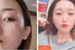 吉林瑞澳醫(yī)學(xué)美容醫(yī)院魏軍劍整形價(jià)格表附激光祛斑案例展示