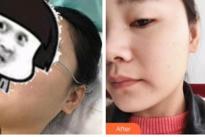 吉林省公安邊防總隊(duì)醫(yī)院醫(yī)整形美容中心張國強(qiáng)整形價(jià)格表附光子嫩膚案例展示