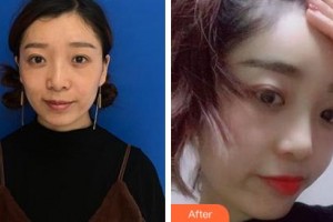 吉林瑞澳醫(yī)學(xué)美容醫(yī)院張建亮整形價(jià)格表附玻尿酸精華導(dǎo)入案例展示