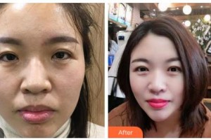 吉林省公安邊防總隊(duì)醫(yī)院醫(yī)整形美容中心王軍整形價(jià)格表附彩光嫩膚案例展示