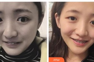 吉林銘醫(yī)整形美容醫(yī)院詹柏華整形價(jià)格表附金屬托槽矯正案例展示