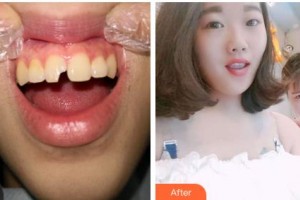 吉林中妍整形美容醫(yī)院姜雪整形價(jià)格表附美白貼片案例展示