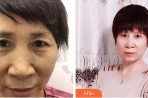 吉林市中心醫(yī)院燒傷整形外科宋博住院醫(yī)師整形價(jià)格表附切眉術(shù)案例展示